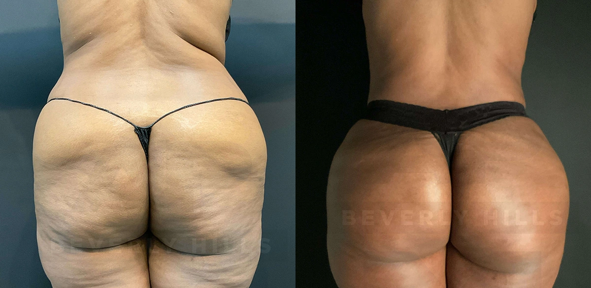 Real Patient Results of Dr. Andre P. Marshall providing Plastic Surgery services to his Beverly Hills & Los Angeles patients.