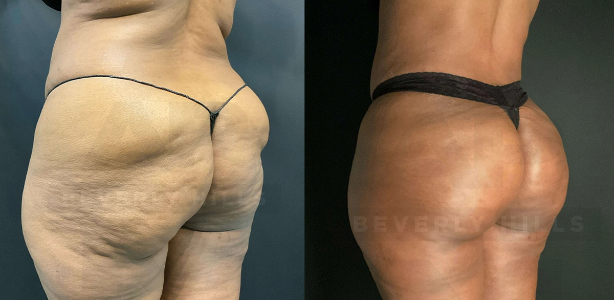 Real Patient Results of Dr. Andre P. Marshall providing Plastic Surgery services to his Beverly Hills & Los Angeles patients.