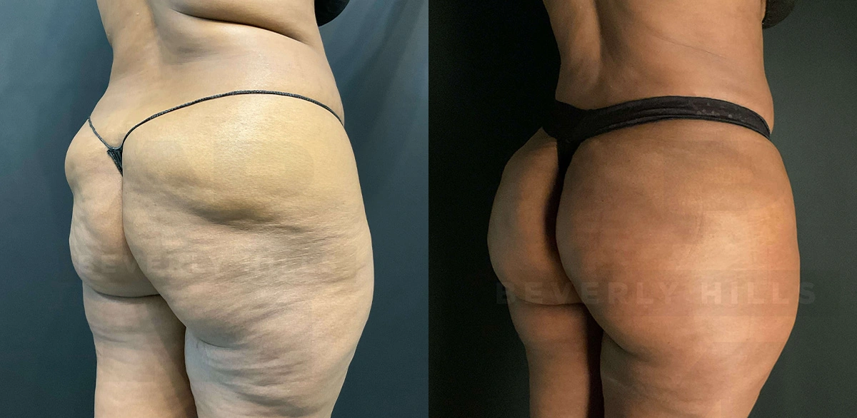 Real Patient Results of Dr. Andre P. Marshall providing Plastic Surgery services to his Beverly Hills & Los Angeles patients.