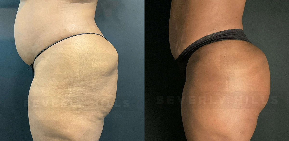 Real Patient Results of Dr. Andre P. Marshall providing Plastic Surgery services to his Beverly Hills & Los Angeles patients.