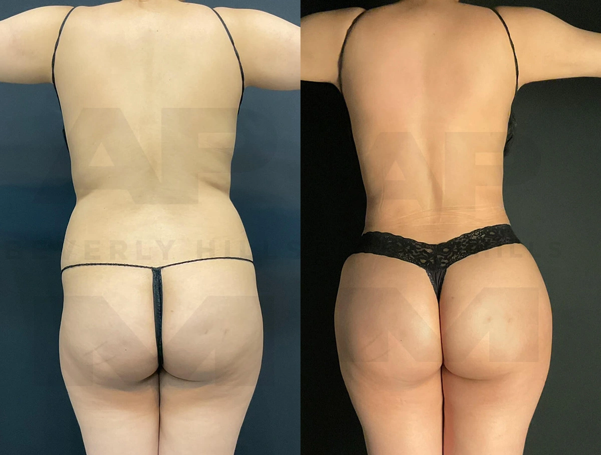 Real Patient Results of Dr. Andre P. Marshall providing Plastic Surgery services to his Beverly Hills & Los Angeles patients.