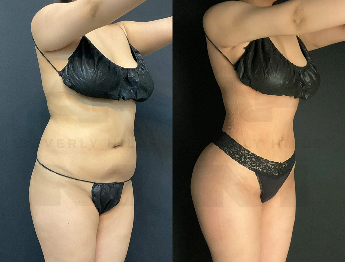 Real Patient Results of Dr. Andre P. Marshall providing Plastic Surgery services to his Beverly Hills & Los Angeles patients.