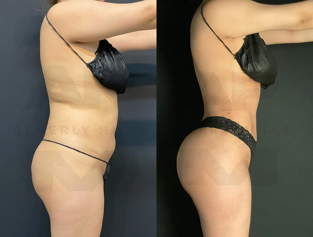 Real Patient Results of Dr. Andre P. Marshall providing Plastic Surgery services to his Beverly Hills & Los Angeles patients.