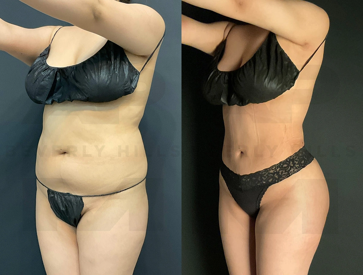 Real Patient Results of Dr. Andre P. Marshall providing Plastic Surgery services to his Beverly Hills & Los Angeles patients.