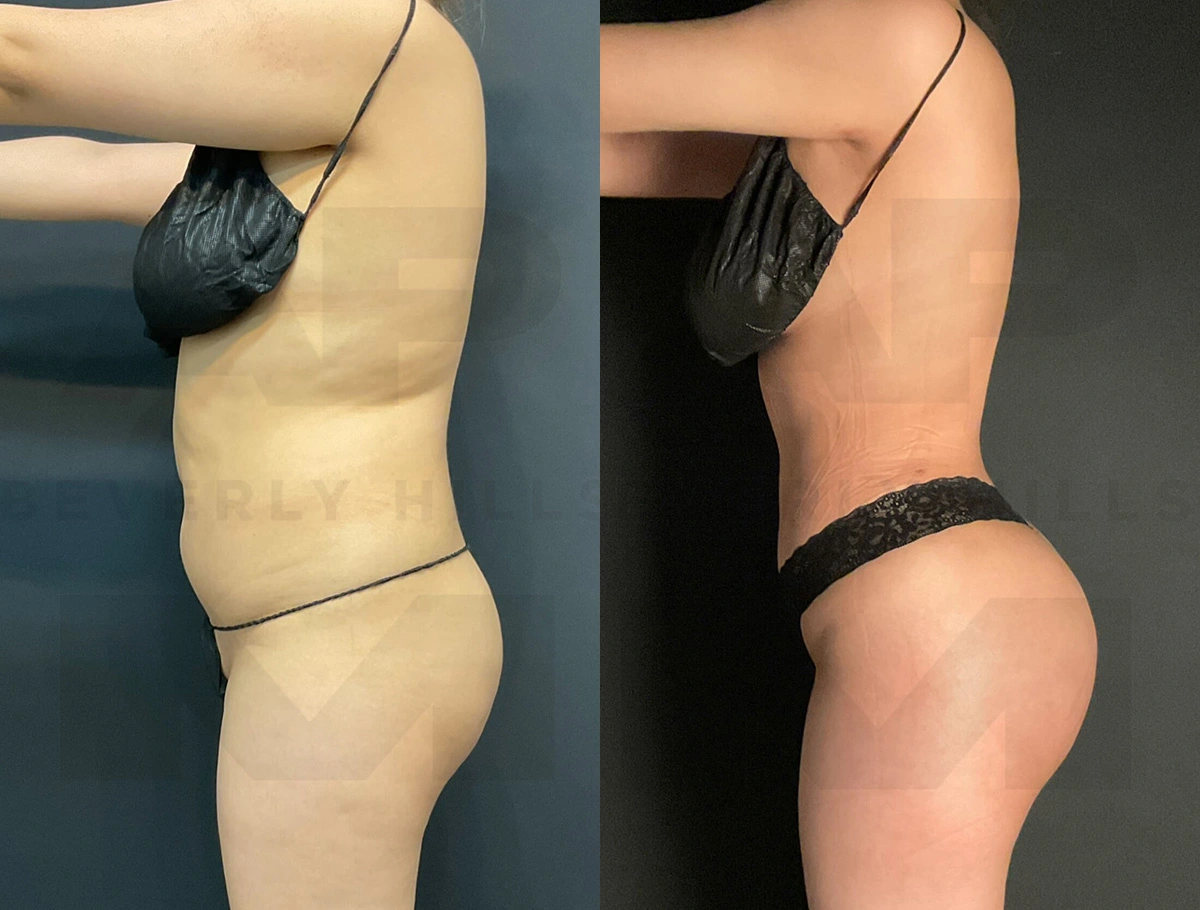 Real Patient Results of Dr. Andre P. Marshall providing Plastic Surgery services to his Beverly Hills & Los Angeles patients.