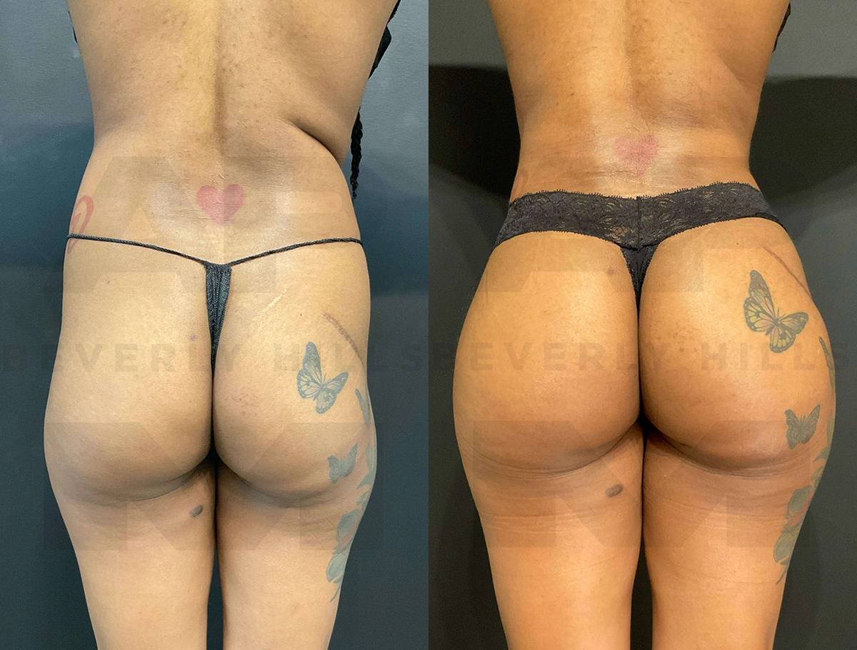 Real Patient Results of Dr. Andre P. Marshall providing Plastic Surgery services to his Beverly Hills & Los Angeles patients.