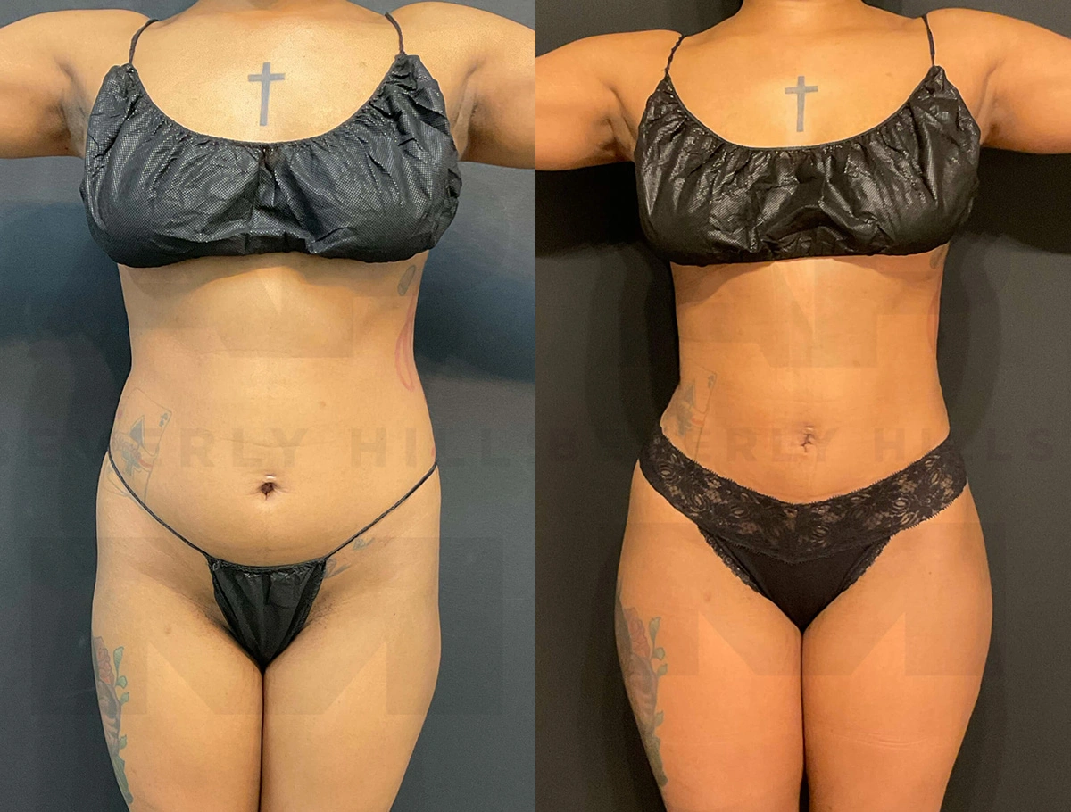 Real Patient Results of Dr. Andre P. Marshall providing Plastic Surgery services to his Beverly Hills & Los Angeles patients.