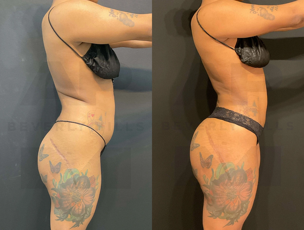 Real Patient Results of Dr. Andre P. Marshall providing Plastic Surgery services to his Beverly Hills & Los Angeles patients.