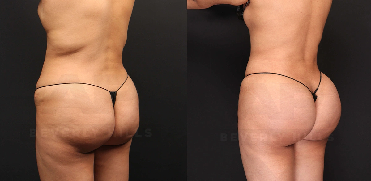 Real Patient Results of Dr. Andre P. Marshall providing Plastic Surgery services to his Beverly Hills & Los Angeles patients.