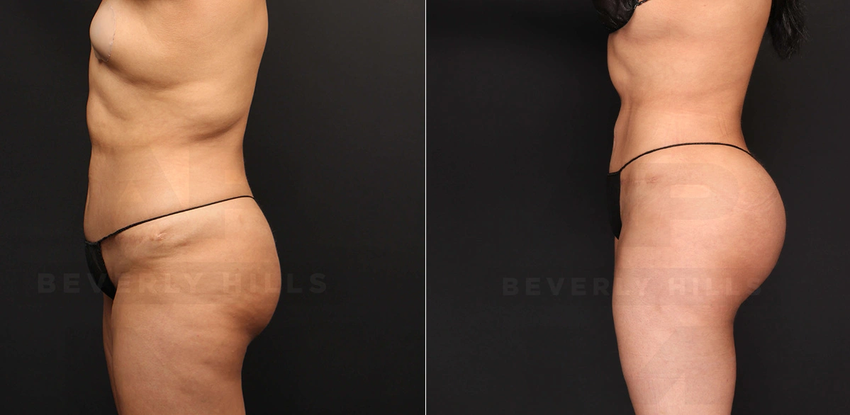 Real Patient Results of Dr. Andre P. Marshall providing Plastic Surgery services to his Beverly Hills & Los Angeles patients.