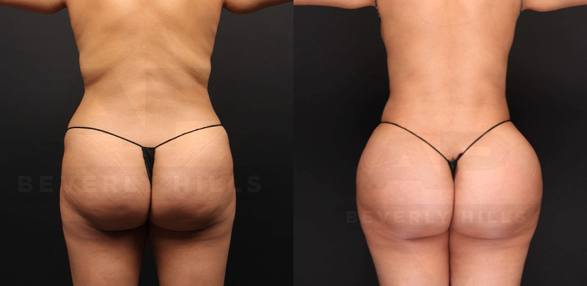 Real Patient Results of Dr. Andre P. Marshall providing Plastic Surgery services to his Beverly Hills & Los Angeles patients.