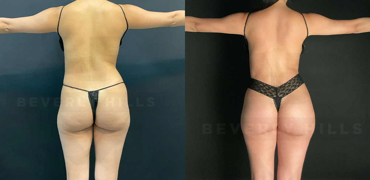 Real Patient Results of Dr. Andre P. Marshall providing Plastic Surgery services to his Beverly Hills & Los Angeles patients.