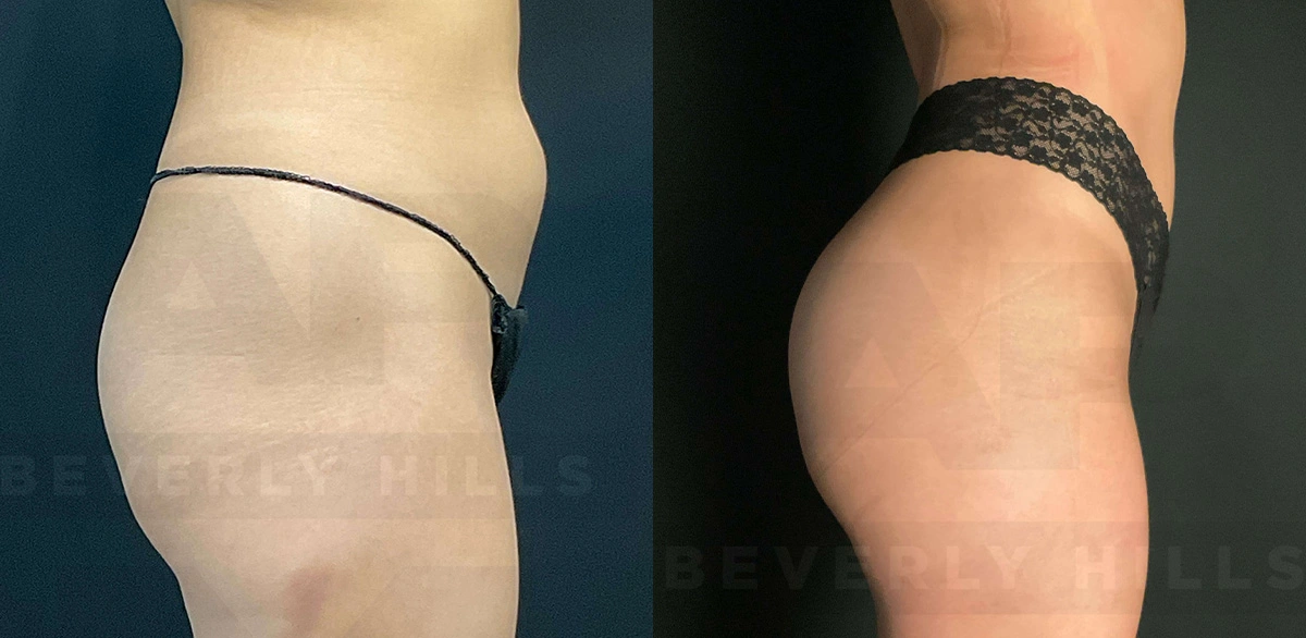 Real Patient Results of Dr. Andre P. Marshall providing Plastic Surgery services to his Beverly Hills & Los Angeles patients.