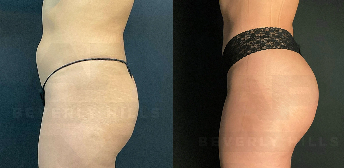 Real Patient Results of Dr. Andre P. Marshall providing Plastic Surgery services to his Beverly Hills & Los Angeles patients.