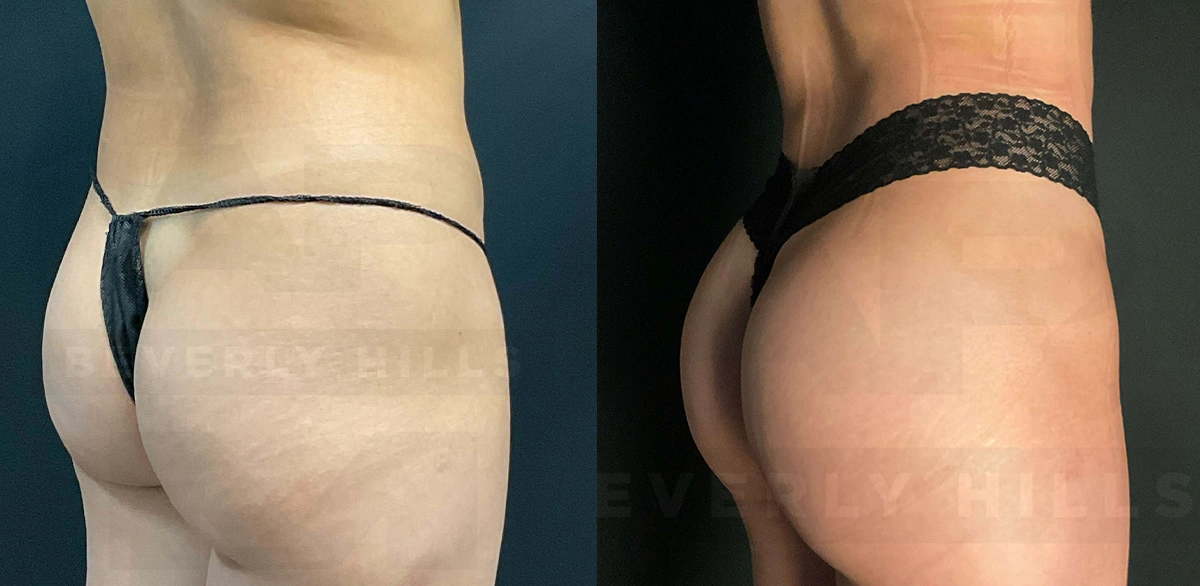 Real Patient Results of Dr. Andre P. Marshall providing Plastic Surgery services to his Beverly Hills & Los Angeles patients.