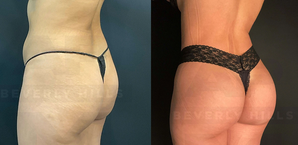 Real Patient Results of Dr. Andre P. Marshall providing Plastic Surgery services to his Beverly Hills & Los Angeles patients.