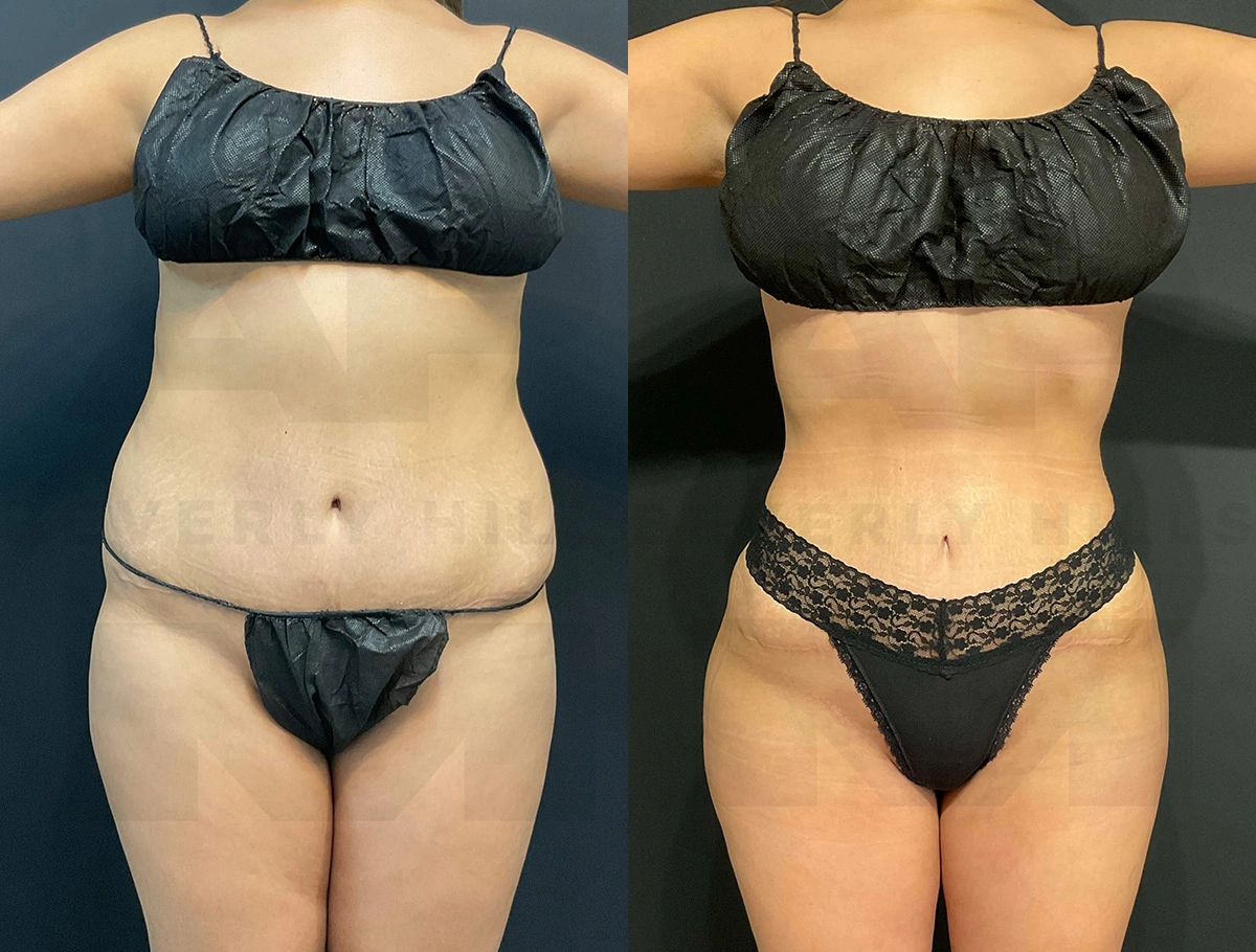 Real Patient Results of Dr. Andre P. Marshall providing Plastic Surgery services to his Beverly Hills & Los Angeles patients.