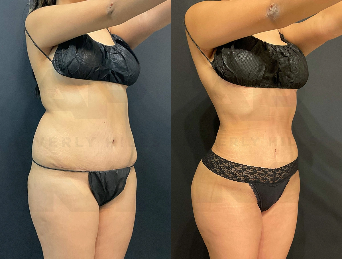 Real Patient Results of Dr. Andre P. Marshall providing Plastic Surgery services to his Beverly Hills & Los Angeles patients.