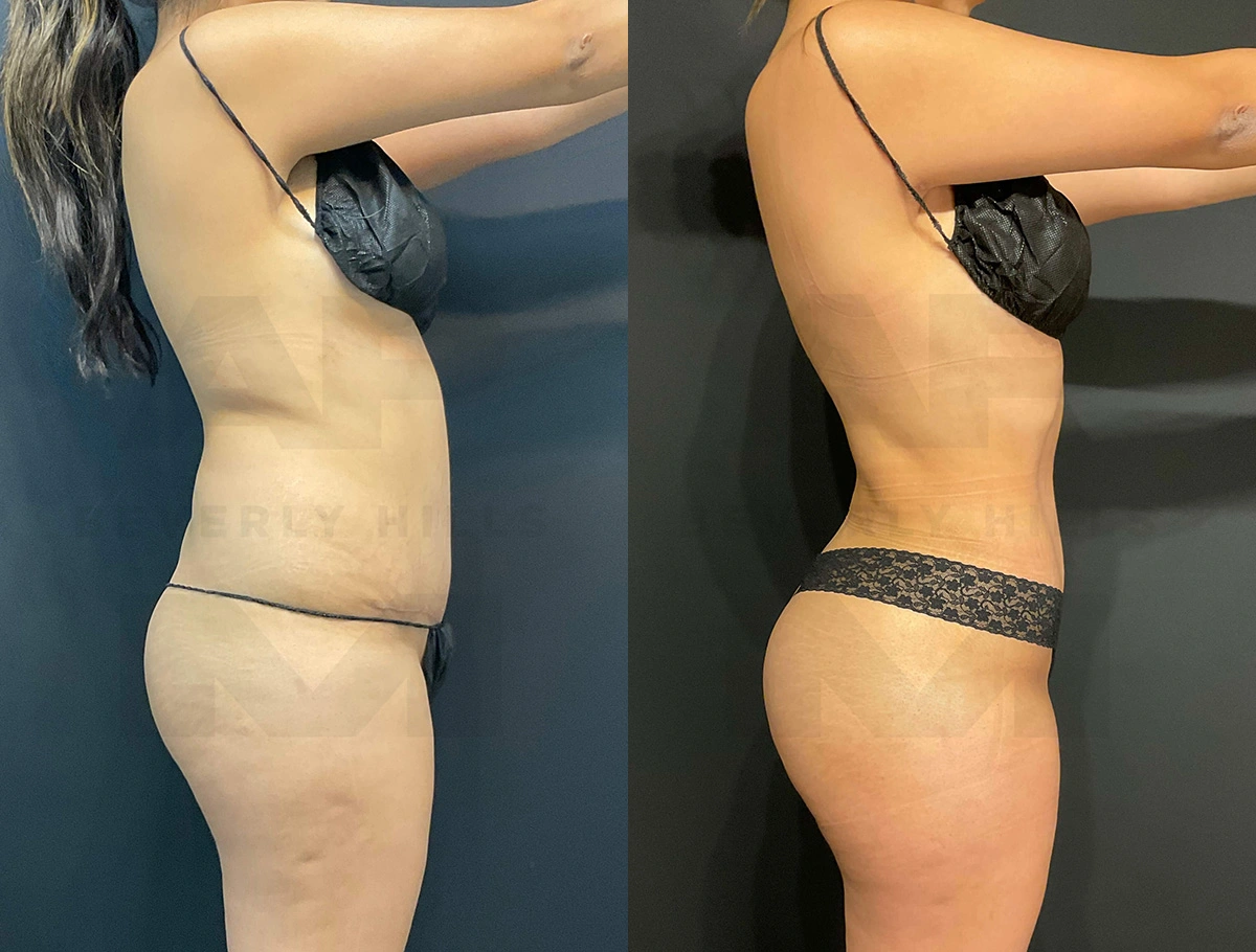 Real Patient Results of Dr. Andre P. Marshall providing Plastic Surgery services to his Beverly Hills & Los Angeles patients.