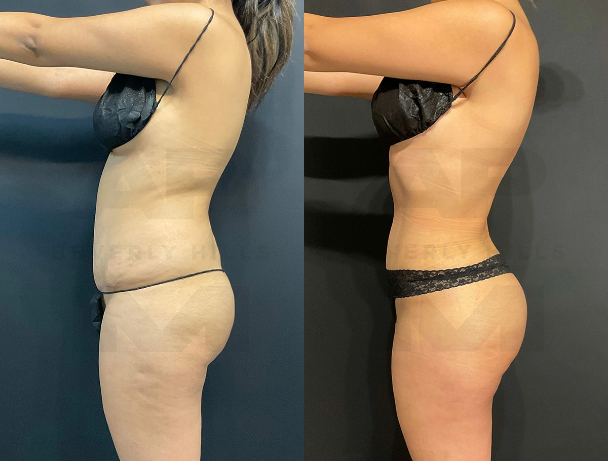 Real Patient Results of Dr. Andre P. Marshall providing Plastic Surgery services to his Beverly Hills & Los Angeles patients.