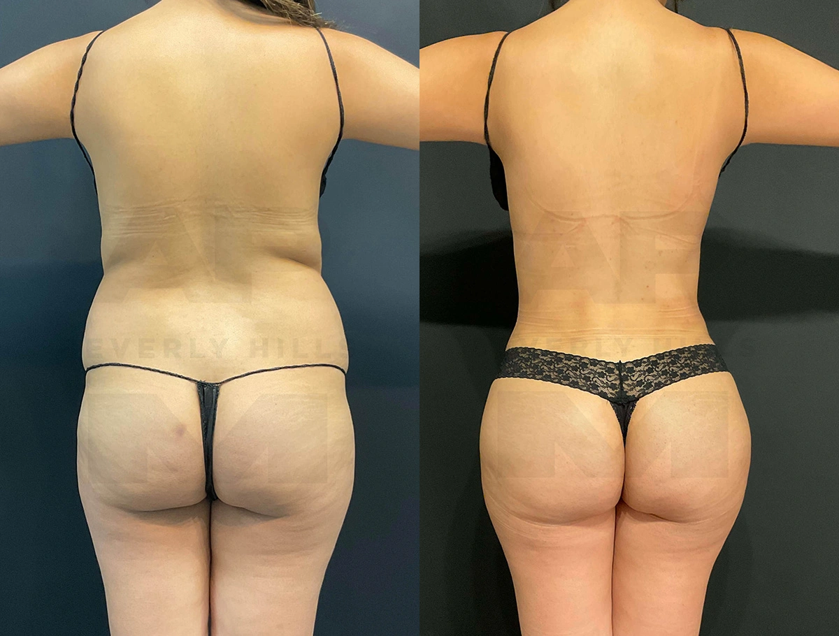 Real Patient Results of Dr. Andre P. Marshall providing Plastic Surgery services to his Beverly Hills & Los Angeles patients.