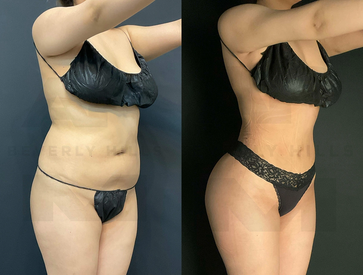 Real Patient Results of Dr. Andre P. Marshall providing Plastic Surgery services to his Beverly Hills & Los Angeles patients.