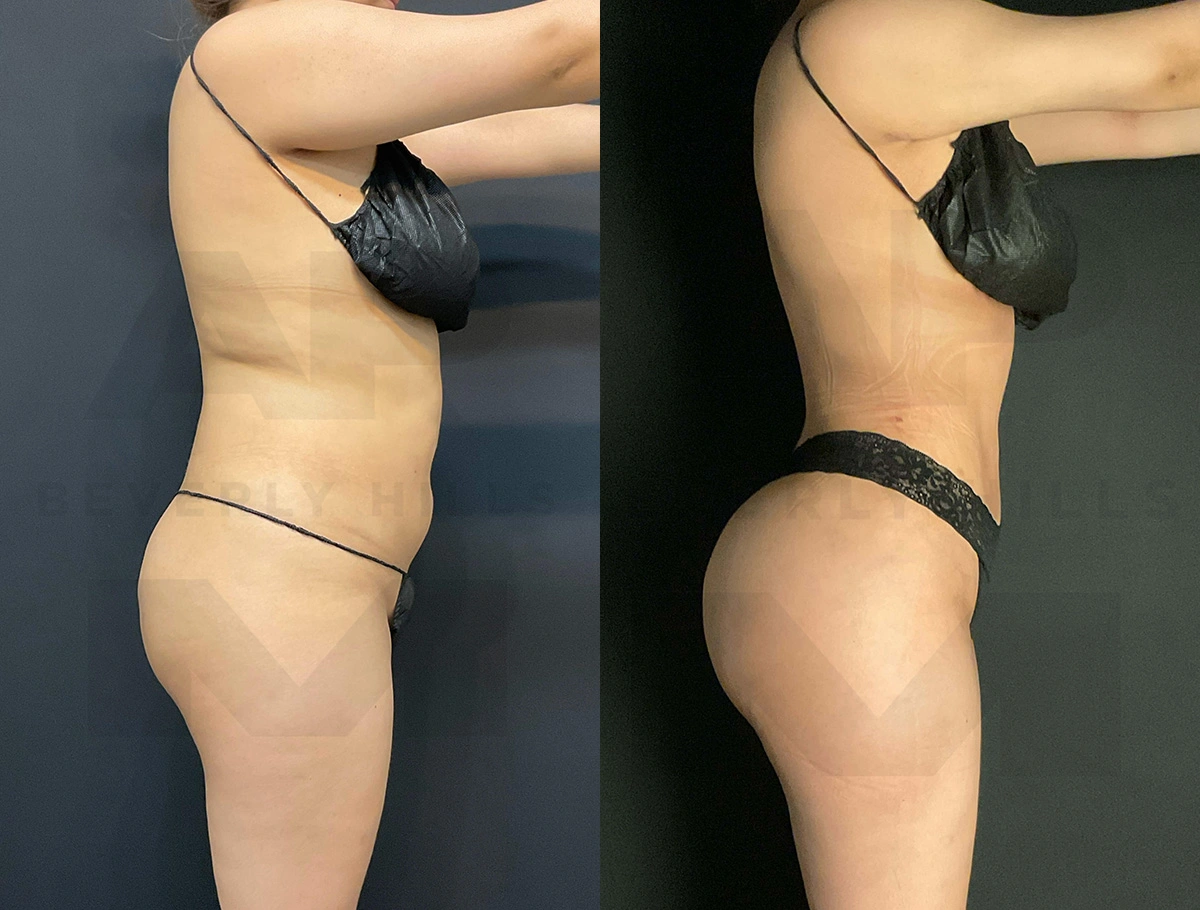 Real Patient Results of Dr. Andre P. Marshall providing Plastic Surgery services to his Beverly Hills & Los Angeles patients.