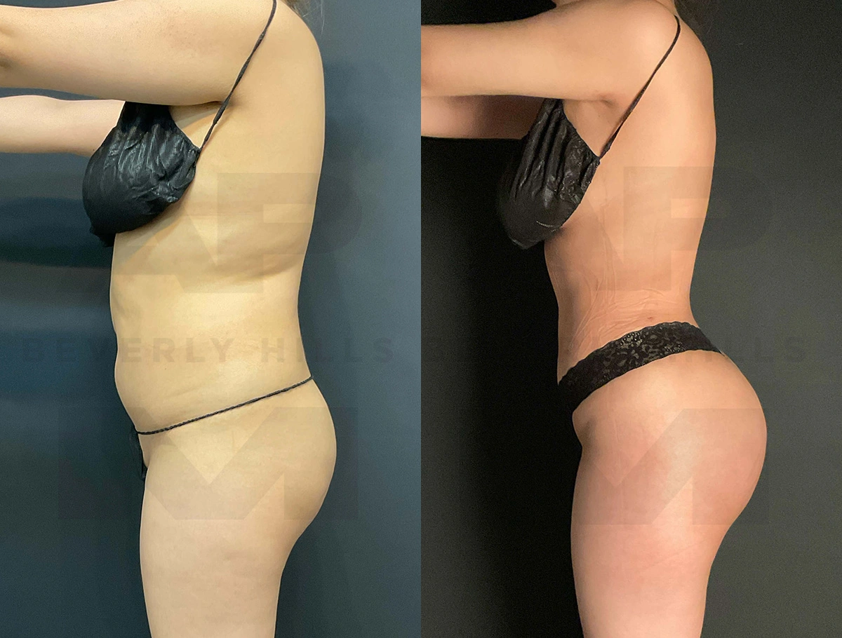 Real Patient Results of Dr. Andre P. Marshall providing Plastic Surgery services to his Beverly Hills & Los Angeles patients.