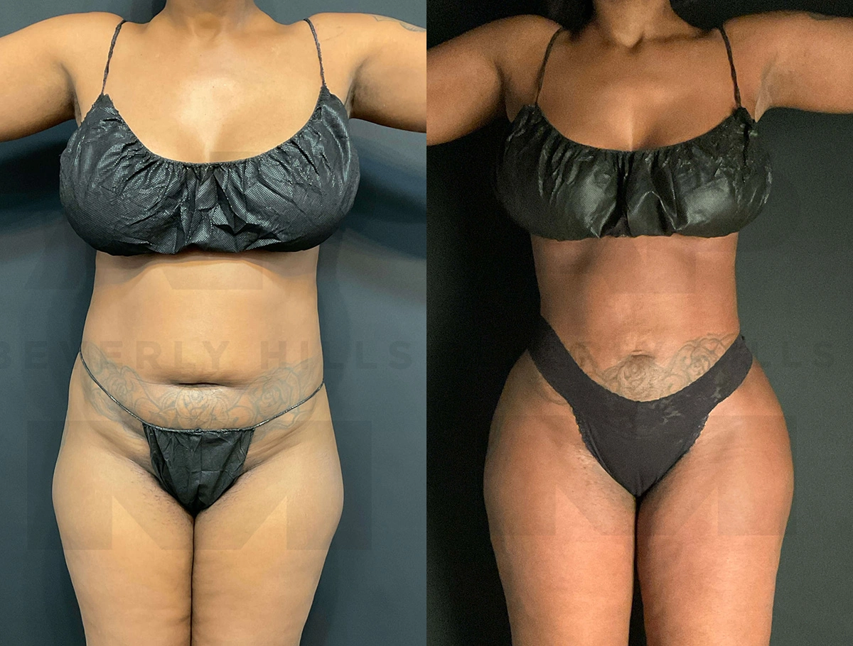 Real Patient Results of Dr. Andre P. Marshall providing Plastic Surgery services to his Beverly Hills & Los Angeles patients.