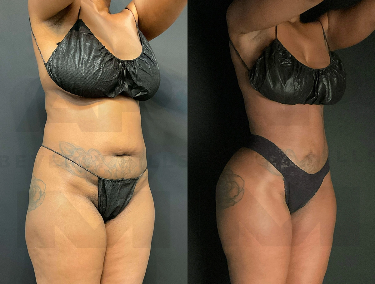 Real Patient Results of Dr. Andre P. Marshall providing Plastic Surgery services to his Beverly Hills & Los Angeles patients.