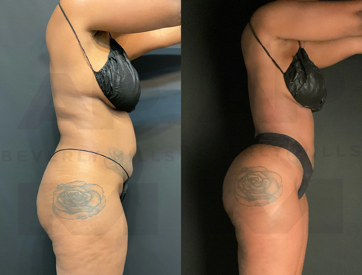 Real Patient Results of Dr. Andre P. Marshall providing Plastic Surgery services to his Beverly Hills & Los Angeles patients.