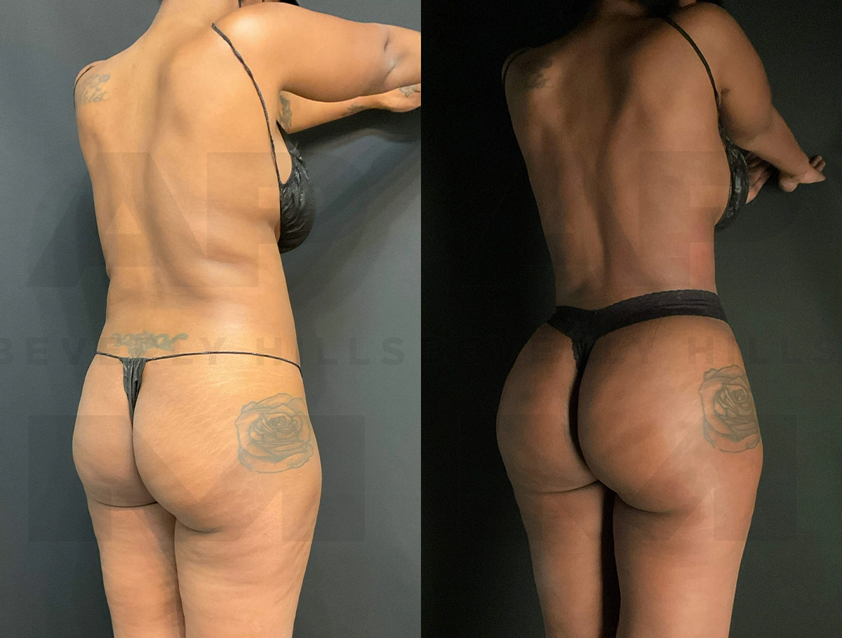 Real Patient Results of Dr. Andre P. Marshall providing Plastic Surgery services to his Beverly Hills & Los Angeles patients.