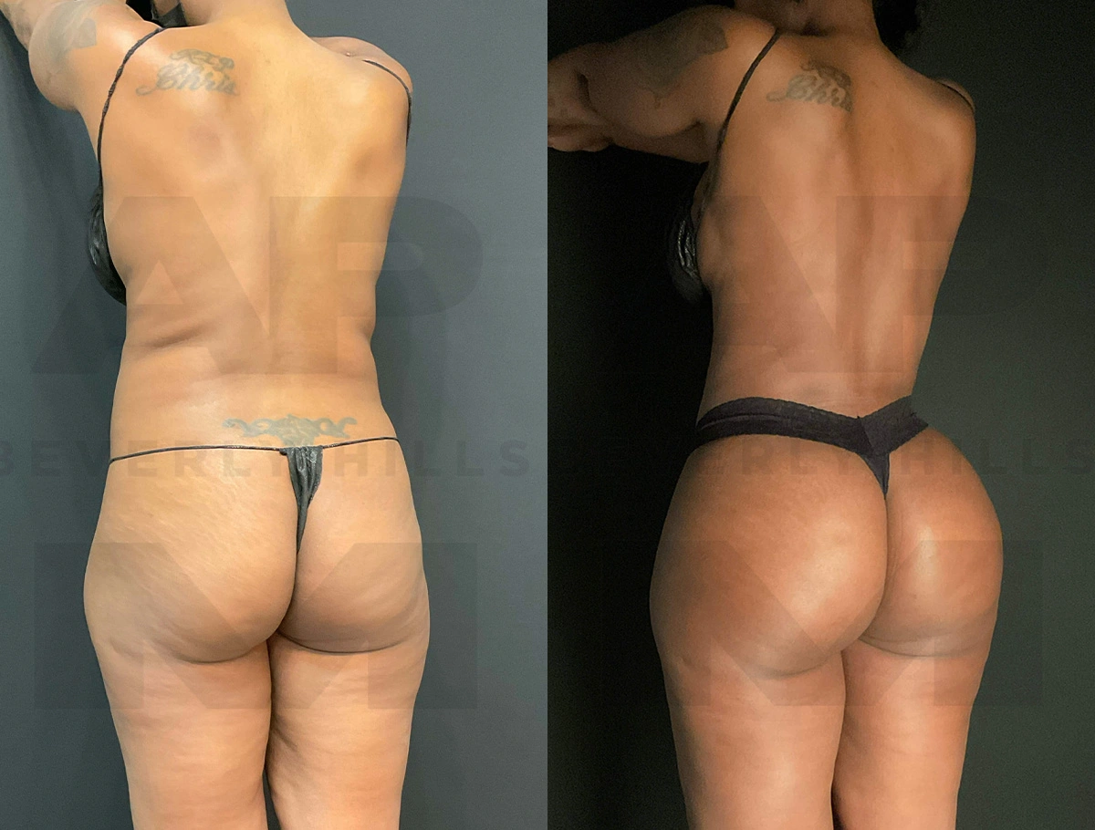 Real Patient Results of Dr. Andre P. Marshall providing Plastic Surgery services to his Beverly Hills & Los Angeles patients.