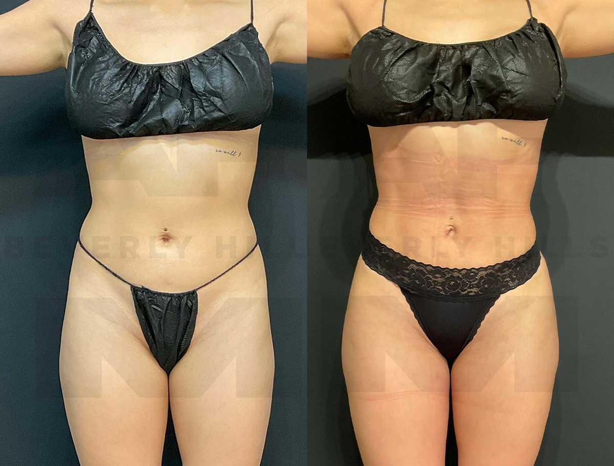 Real Patient Results of Dr. Andre P. Marshall providing Plastic Surgery services to his Beverly Hills & Los Angeles patients.