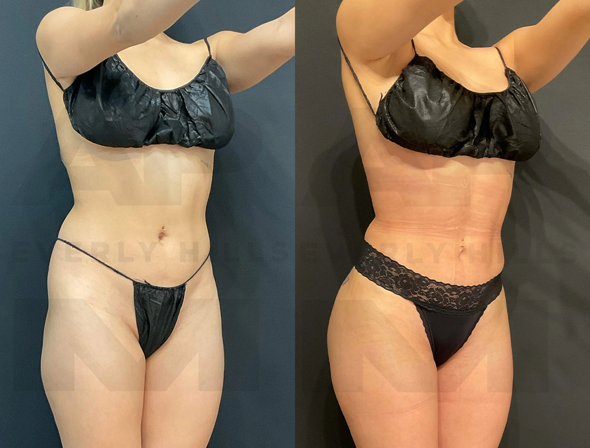 Real Patient Results of Dr. Andre P. Marshall providing Plastic Surgery services to his Beverly Hills & Los Angeles patients.