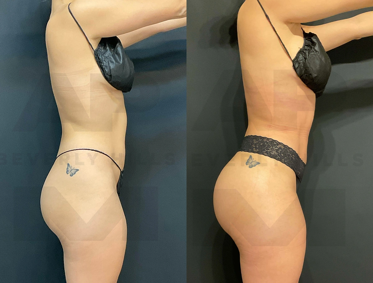 Real Patient Results of Dr. Andre P. Marshall providing Plastic Surgery services to his Beverly Hills & Los Angeles patients.