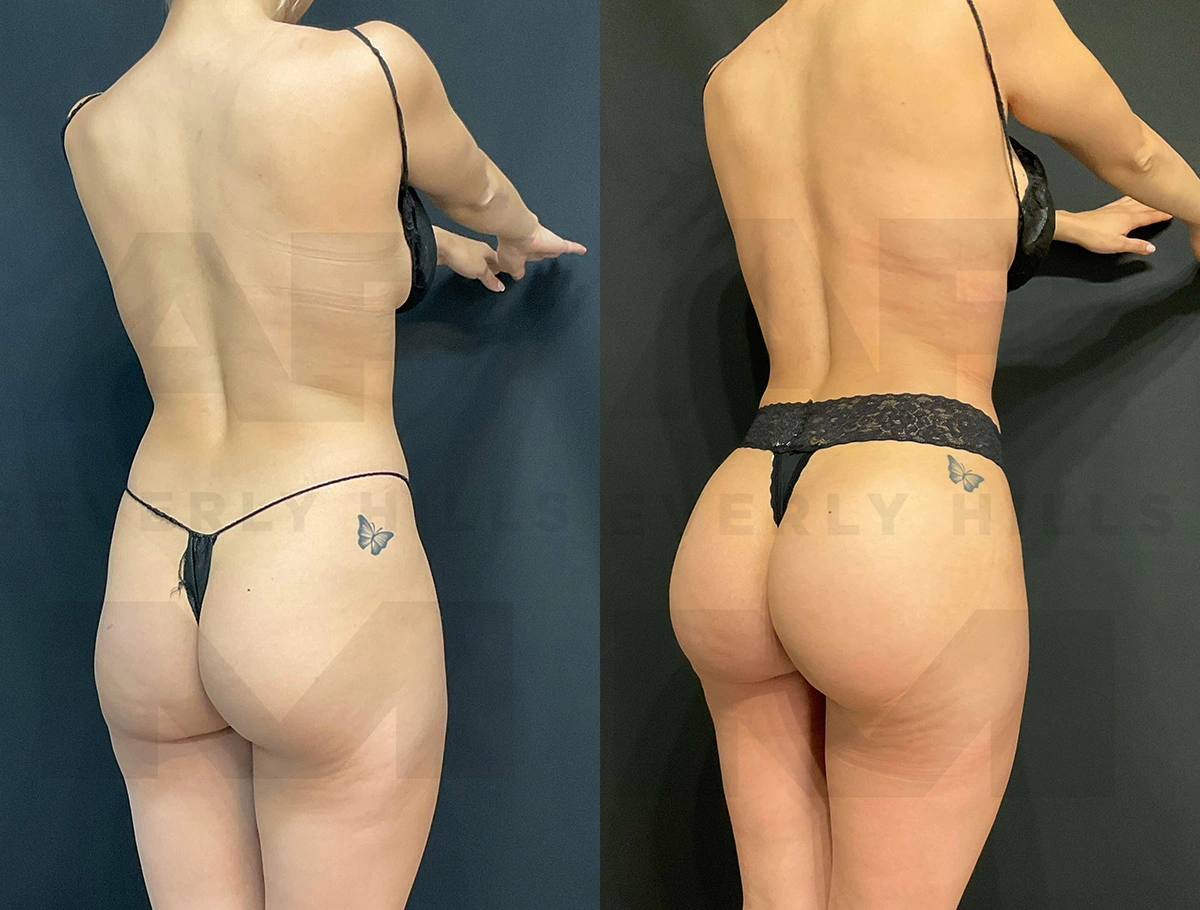 Real Patient Results of Dr. Andre P. Marshall providing Plastic Surgery services to his Beverly Hills & Los Angeles patients.