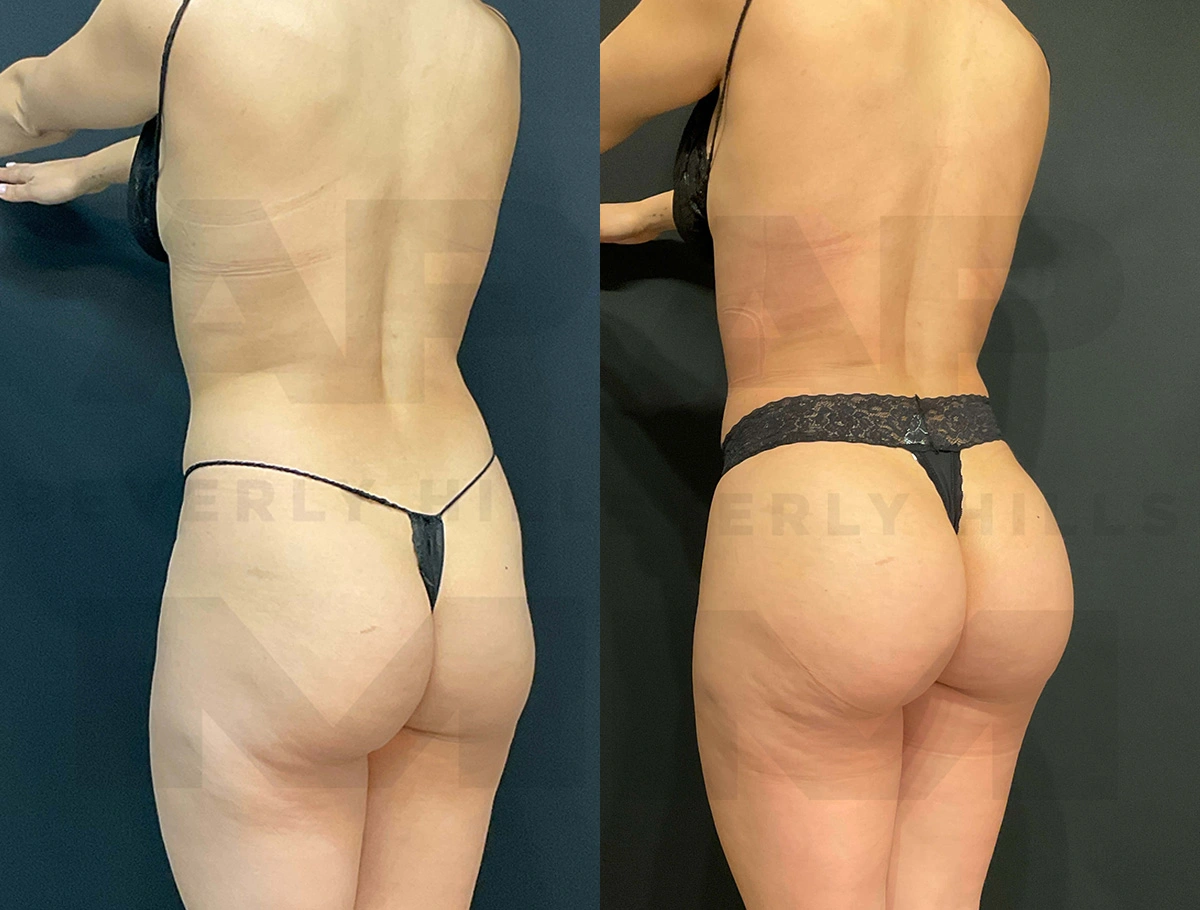 Real Patient Results of Dr. Andre P. Marshall providing Plastic Surgery services to his Beverly Hills & Los Angeles patients.