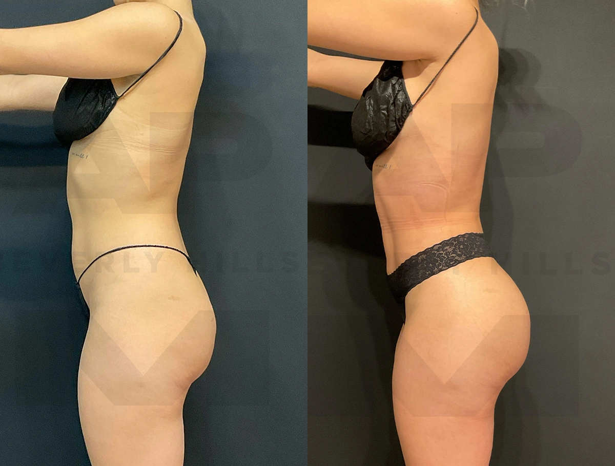 Real Patient Results of Dr. Andre P. Marshall providing Plastic Surgery services to his Beverly Hills & Los Angeles patients.