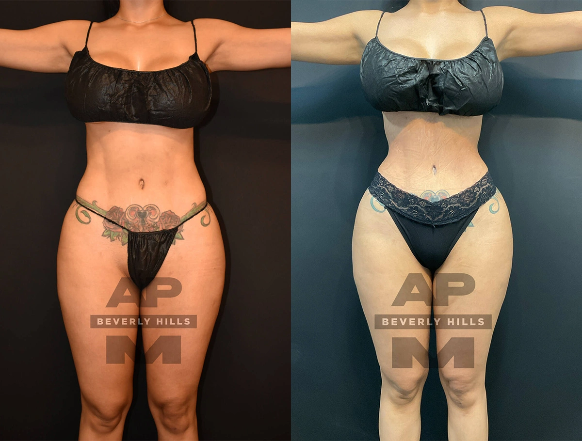 Real Patient Results of Dr. Andre P. Marshall providing Plastic Surgery services to his Beverly Hills & Los Angeles patients.