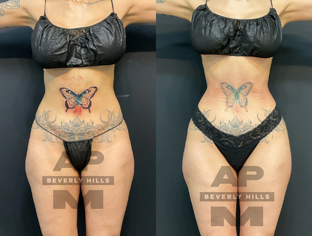 Real Patient Results of Dr. Andre P. Marshall providing Plastic Surgery services to his Beverly Hills & Los Angeles patients.