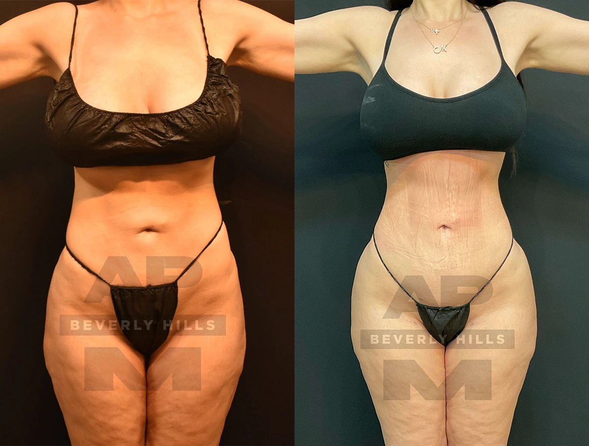 Real Patient Results of Dr. Andre P. Marshall providing Plastic Surgery services to his Beverly Hills & Los Angeles patients.