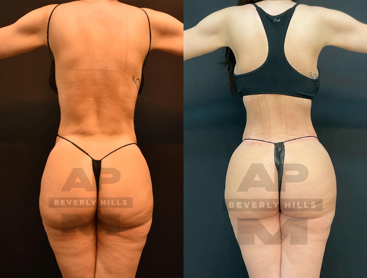 Real Patient Results of Dr. Andre P. Marshall providing Plastic Surgery services to his Beverly Hills & Los Angeles patients.