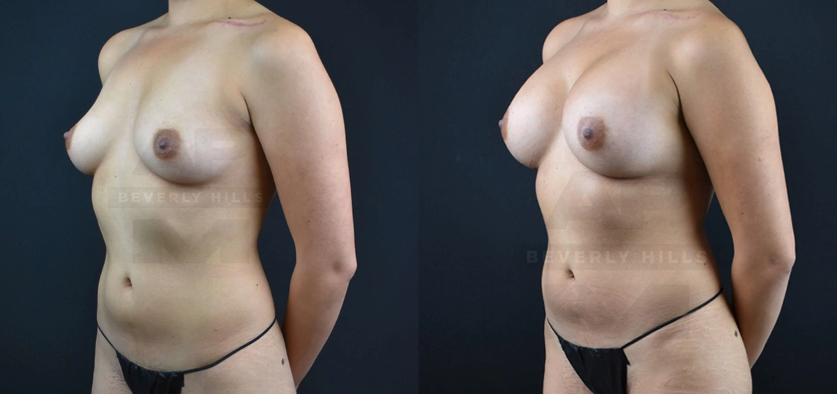 Real Patient Results of Dr. Andre P. Marshall providing Plastic Surgery services to his Beverly Hills & Los Angeles patients.