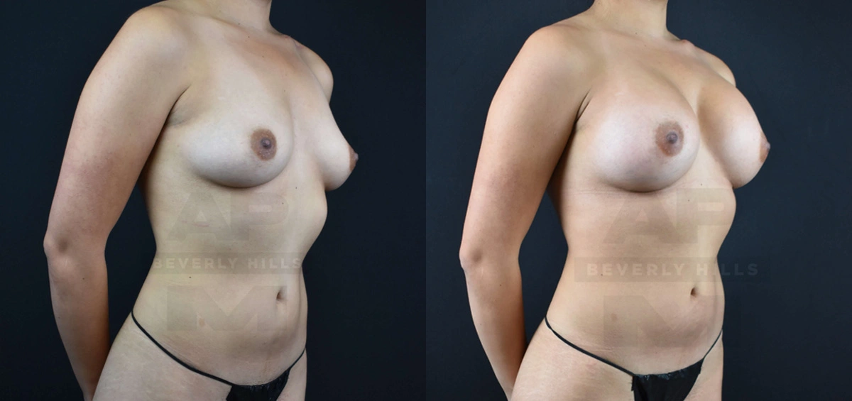 Real Patient Results of Dr. Andre P. Marshall providing Plastic Surgery services to his Beverly Hills & Los Angeles patients.