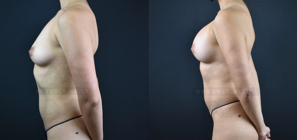 Real Patient Results of Dr. Andre P. Marshall providing Plastic Surgery services to his Beverly Hills & Los Angeles patients.