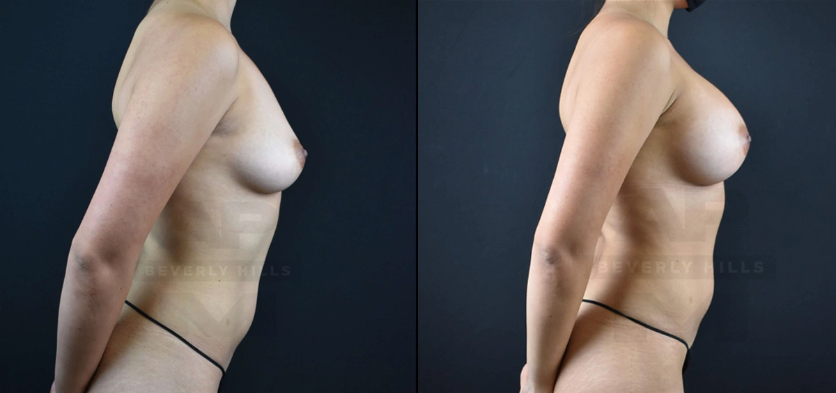 Real Patient Results of Dr. Andre P. Marshall providing Plastic Surgery services to his Beverly Hills & Los Angeles patients.