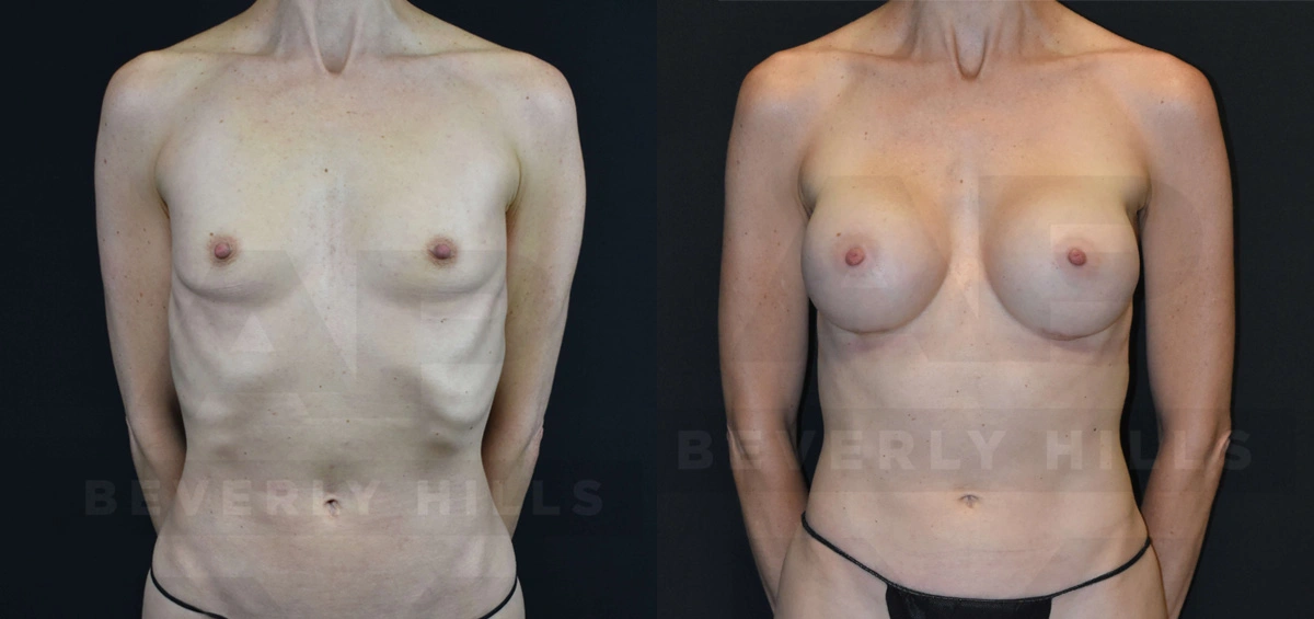 Real Patient Results of Dr. Andre P. Marshall providing Plastic Surgery services to his Beverly Hills & Los Angeles patients.