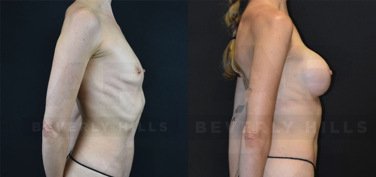 Real Patient Results of Dr. Andre P. Marshall providing Plastic Surgery services to his Beverly Hills & Los Angeles patients.