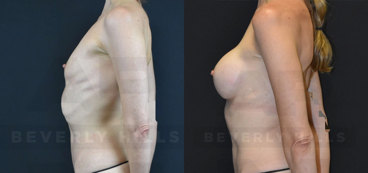 Real Patient Results of Dr. Andre P. Marshall providing Plastic Surgery services to his Beverly Hills & Los Angeles patients.